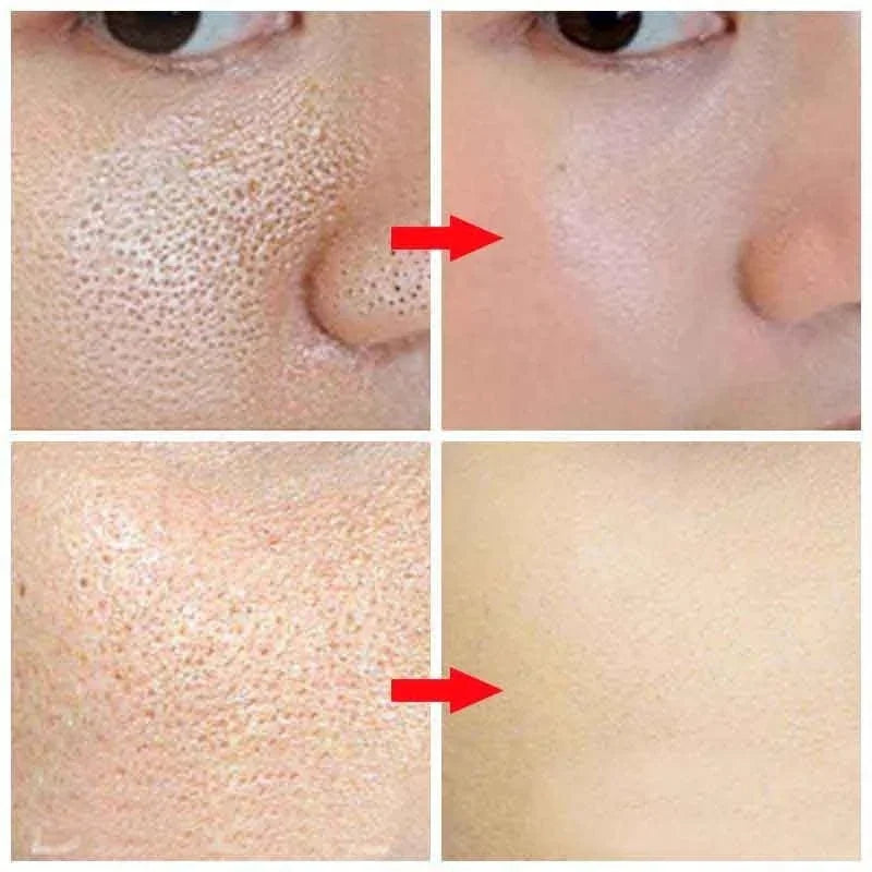 Before and after images showing reduced face pores and smoother skin texture